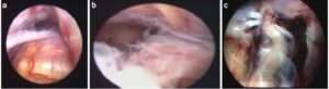 rottura del tendine d'achille ricostruzione endoscopica
