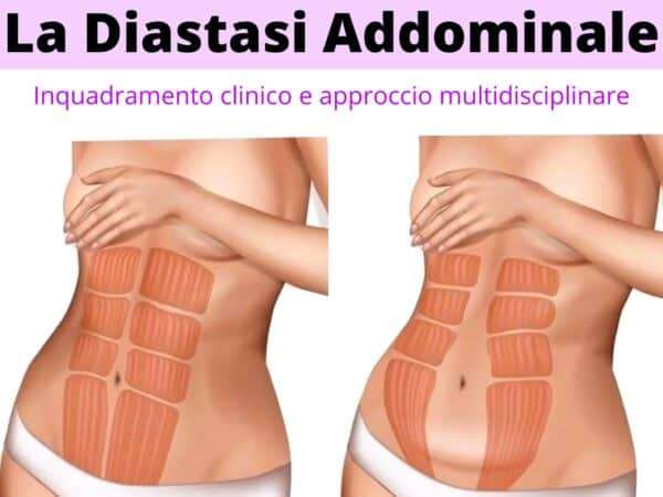 La diastasi addominale